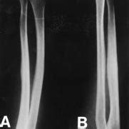 Initial Anteroposterior A And Lateral B Radiographs Of The Right