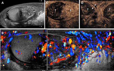 Sonography Of Scrotal Wall Lesions And Correlation With Other