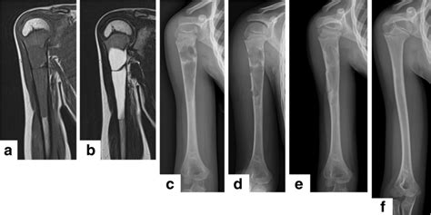 The Typical Case Of Simple Bone Cyst In The Right Humerus Treated With Download Scientific