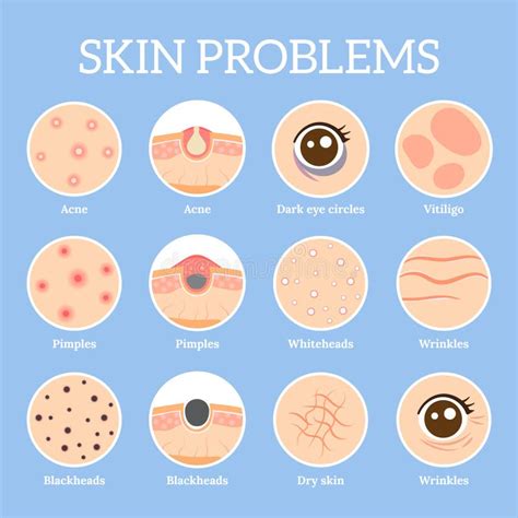 Causes of Acne. Skin Problems and Diseases Beauty Infographics Stock Vector - Illustration of ...