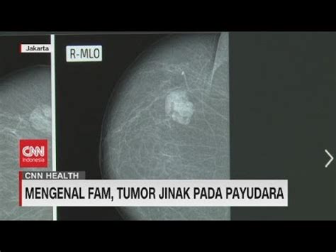 Mengenal Fam Tumor Jinak Pada Payudara CNN Health YouTube