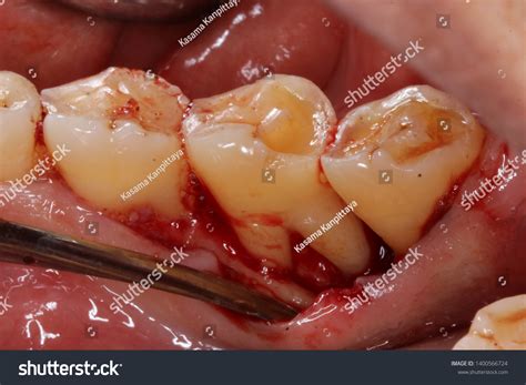 Debridement Dental