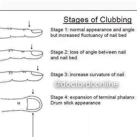 Stages Of Clubbing Medizzy