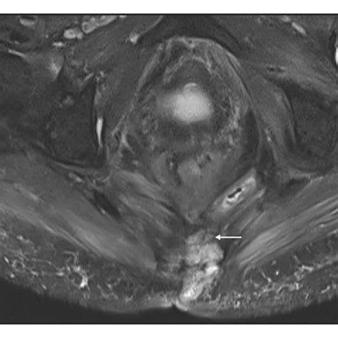 Discitis Osteomyelitis A Sagittal Stir Short Tau Inversion Download Scientific Diagram