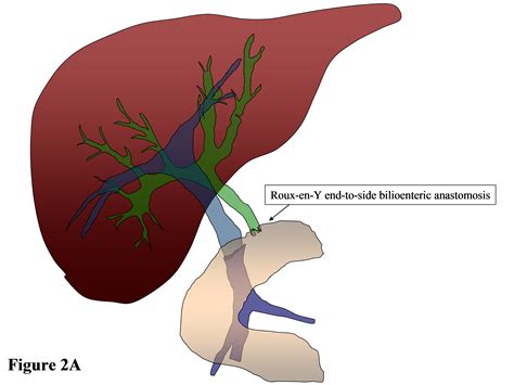 Roux En Y Hepaticojejunostomy Effective Solution To Biliary