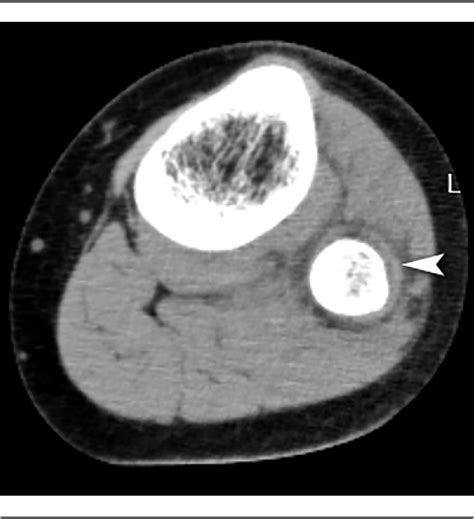 Figure From Acute Hematogenous Escherichia Coli Osteomyelitis Of The