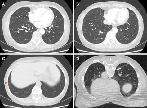 Chest High Resolution Computed Tomography Imaging A C The Three