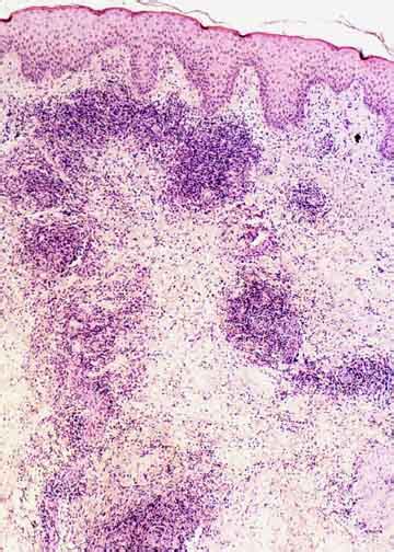 Peripheral T Cell Lymphomas Example 4A