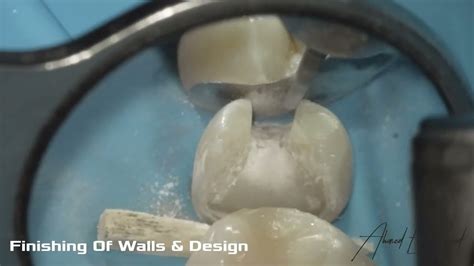 Management Of Deep Caries Indirect Restorations YouTube