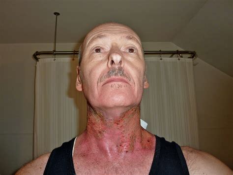 The Art Of Being A Head And Neck Cancer Patient Head And Neck Cancer