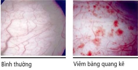 Viêm Bàng Quang Kẽ Những điều Cần Biết Vinmec