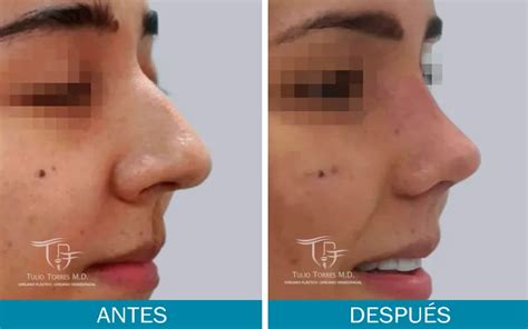 Rinoplastia Ultrasónica Dr Tulio Torres