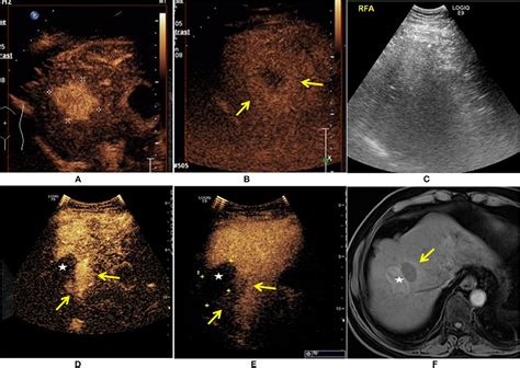 Frontiers The Perfusion Features Of Recurrent Hepatocellular