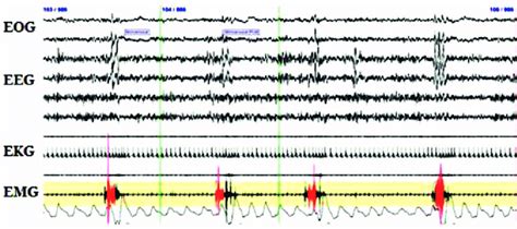 Periodic Limb Movements During Sleep Pictured Is A 2 Minute Epoch That Download Scientific