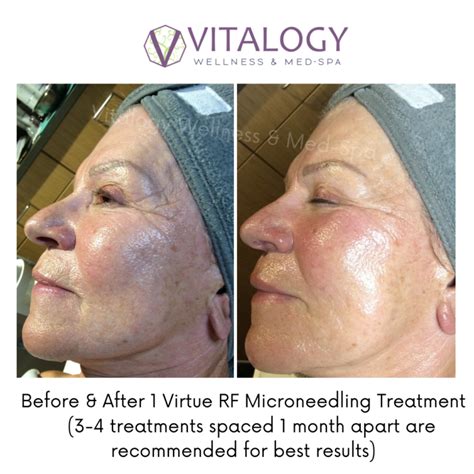 Skin Tightening New Virtue Rf Microneedling Homewood Al