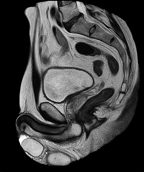 Prostate Imaging Philips Mr Body Map