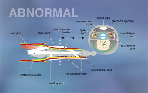 Dupuytrens Disease Hand Surgery Source