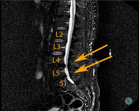 L4 l5 spondylosis: Lumbar spondylosis – Physiopedia