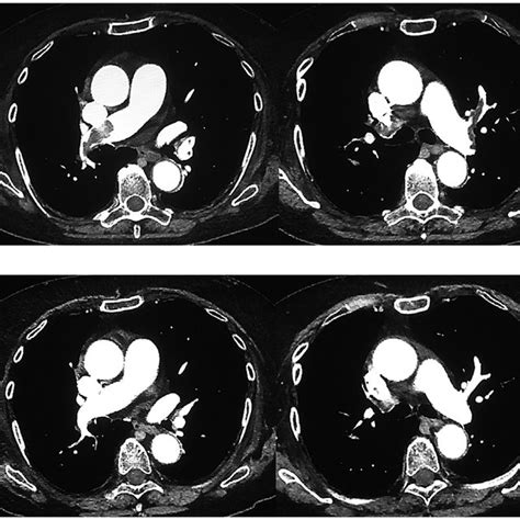 Contrast Computed Tomography Ct Scan Of The Pulmonary Arteries A Download Scientific Diagram