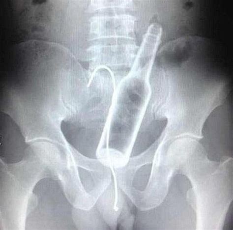 Man Tells Doctors He Has No Idea How Bottle Got Stuck Up His Bum Daily Star