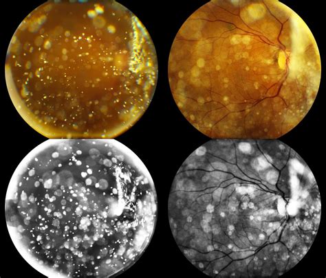 Whitman Images: Asteroid Hyalosis