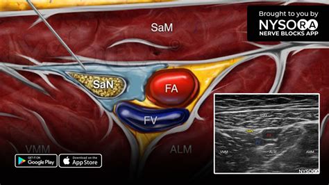 Adductor Canal Nerve Block Ultrasound