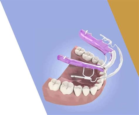Inman Aligner Dental Treatment Experts in Manchester | Kissdental