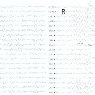 Electroencephalography Of The Patient Electroencephalography A B