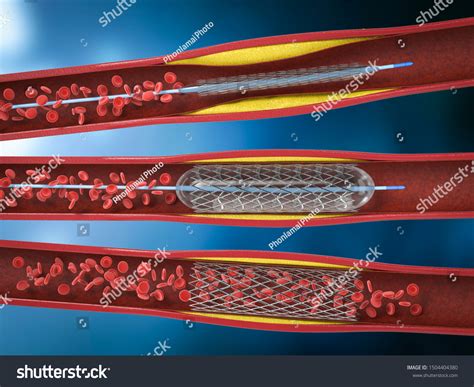 3d Rendering Balloon Angioplasty Procedure Stent Stock Illustration