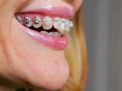 Ceramic Braces Dental Specialists Turramurra