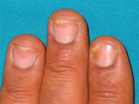 Conseils Pour Le Psoriasis Des Ongles Mon Ongle