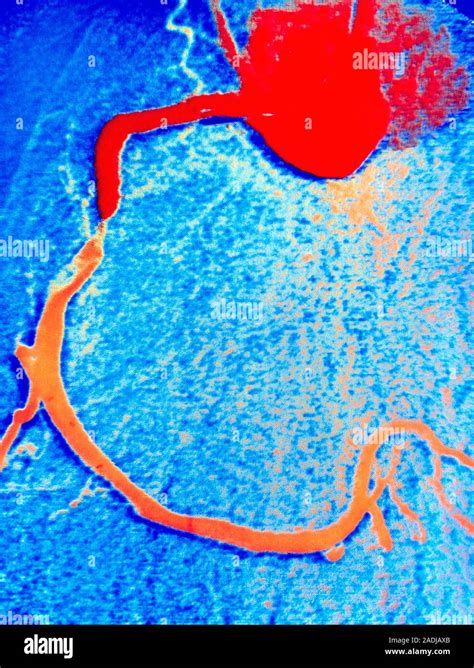 Angioplastia El Angiograma Color Tomadas Durante Una Angioplastia