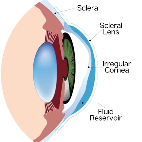 New Scleral Lenses Optometrist Paducah Kentucky Eye Doctor Paducah Ky