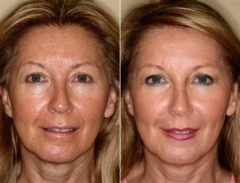 Face Mesotherapy In Iran Skin Rejuvenation Face Mesotherapy Cost