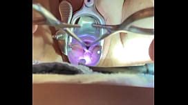 Mature Cervix Prolapsed With Big Bottles Hanging With Catheter Inflated Inserted Into Uterus