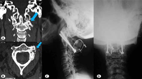 A Coronal And B Axial Computed Tomography Scans Of The Upper Cervical