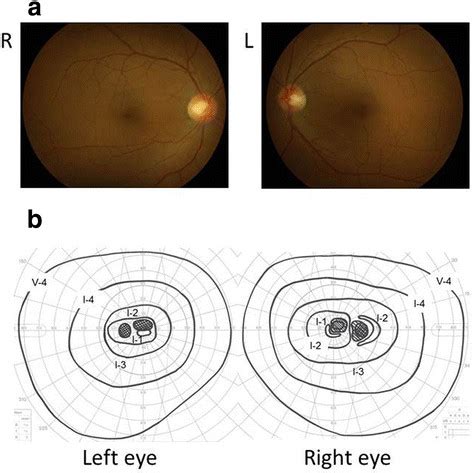 Fundus Photograph A And Goldmann Perimetry B Fundus Appearances