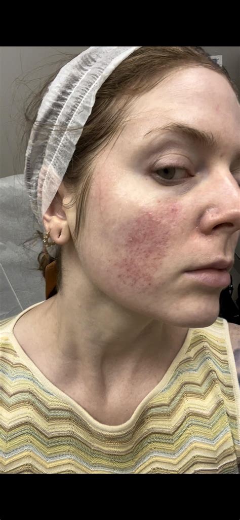 Ipl Before Ipl And Right After Rrosacea