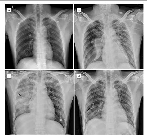 Figure 1 From Re Expansion Pulmonary Edema Post Pneumothorax Semantic