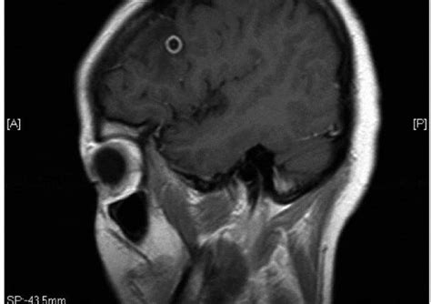 Cisticercosis cerebral Tecnología de Vida