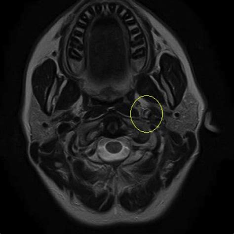 Second MRI of acute left internal carotid artery dissection. | Download ...