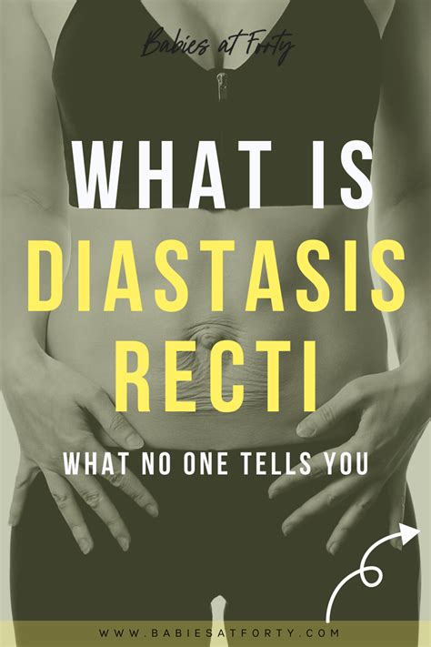 What Is Diastasis Recti What Is Diastasis Recti Mom Advice