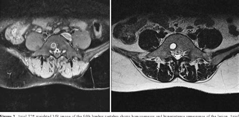 Simple Bone Cyst In The Body Of The Lumbar Vertebra Semantic Scholar