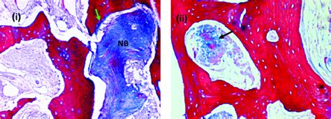 Photomicrographs Showing Neo Bone Formation Nb Note The Neo Bone