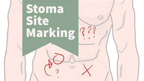 Ostomy Care Stoma Ulcerative Colitis Crohns Ulcers Cancer