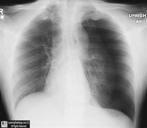 Learningradiology Tension Pneumothorax Ptx Spontaneous Shift Imaging