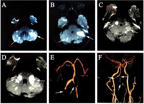 A B 3rd Day Diffusion Weighted Mri Showed Hyperintense Foci At The