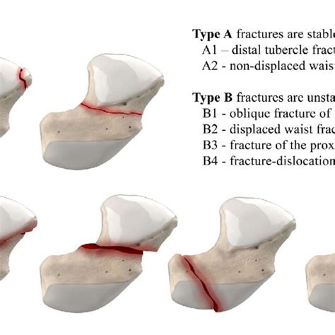 Herbert Classification Of Scaphoid Fractures Type A Fractures Are