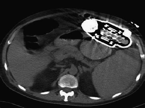 Computed Tomography Scan Demonstrating Enlarged Spleen And Relationship Download Scientific