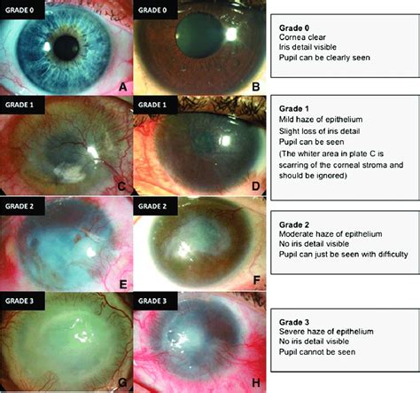 Standardized Grading Plate Used To Grade Corneal Epithelial Haze As